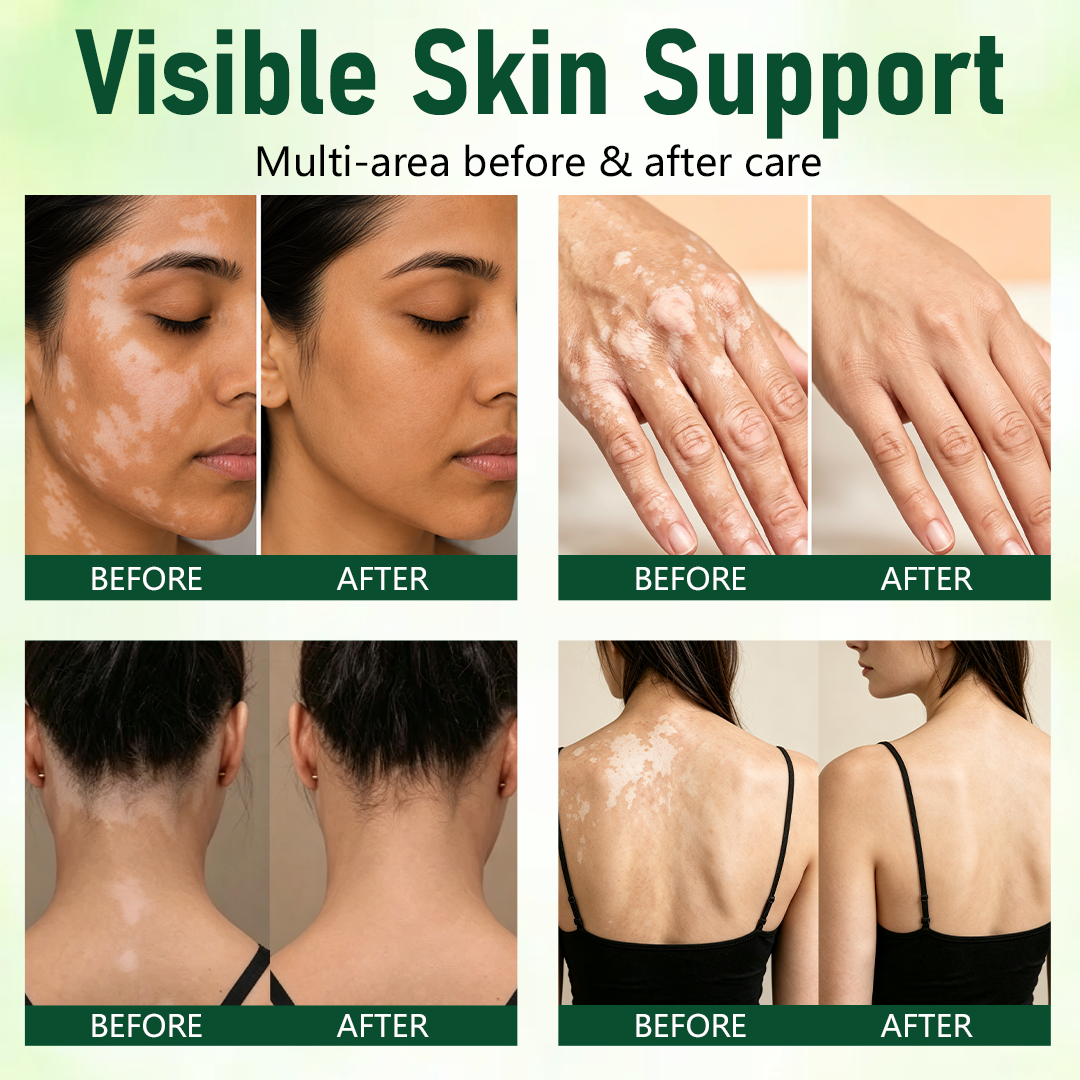 VEAAEV® Herbal Vitiligo Cream