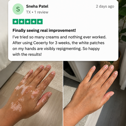VEAAEV® Herbal Vitiligo Cream